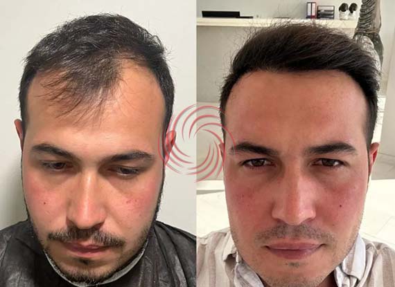 3000 Graft Hair Transplant Before and After