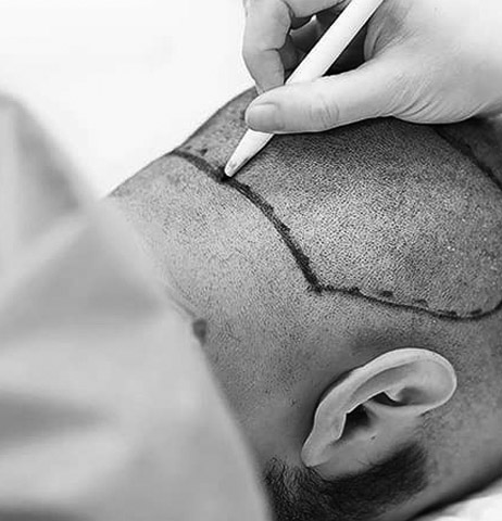 hair transplant frequently asked questions