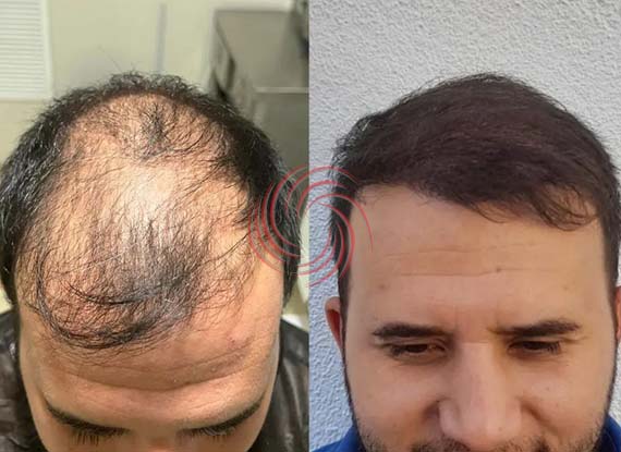 saç ekim öncesi sonrası 4