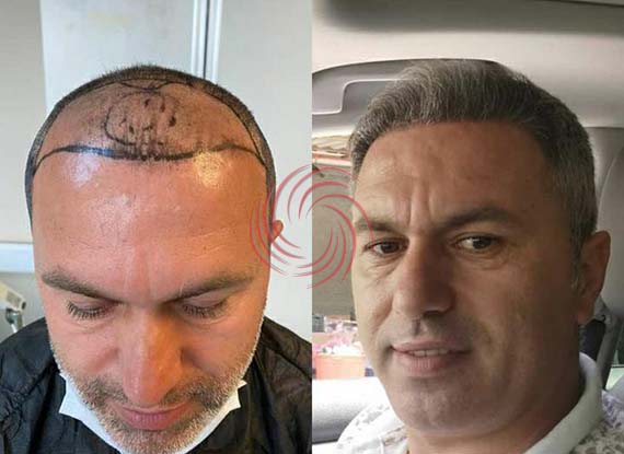 до и после пересадки волос 8